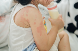 Toddler drinking milk with rash on arms to illustrate allergens legislation uk