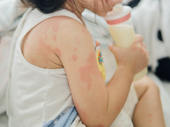 Toddler drinking milk with rash on arms to illustrate allergens legislation uk